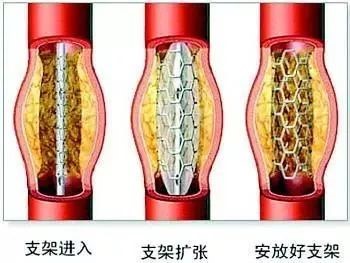 支架.jpg